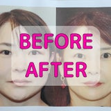 眉下鼻下整形手術、意外な2次効果と2年後のビフォーアフターの記事画像